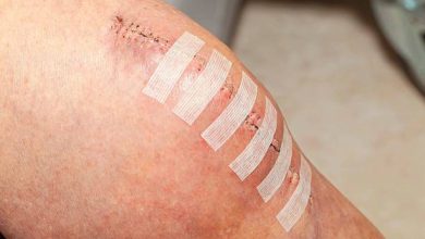 Có cần phẫu thuật thay khớp gối không? Hướng dẫn chuẩn bị, phục hồi và những điều cần biết về quy trình phổ biến này